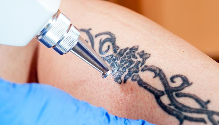 Tattoo Removal Alternatives
