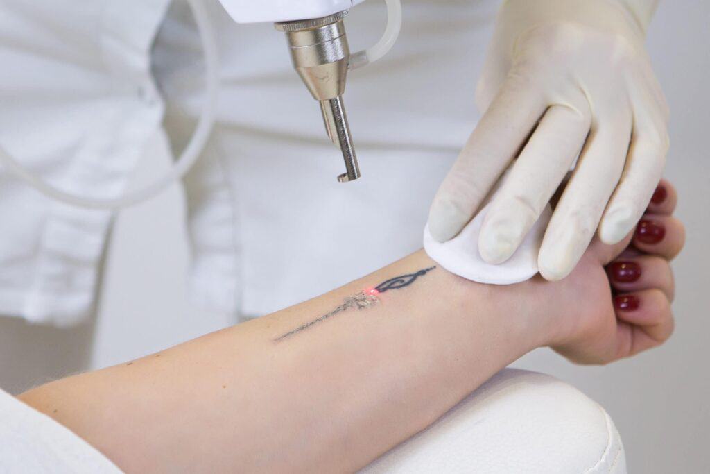 Tattoo Removal Alternatives