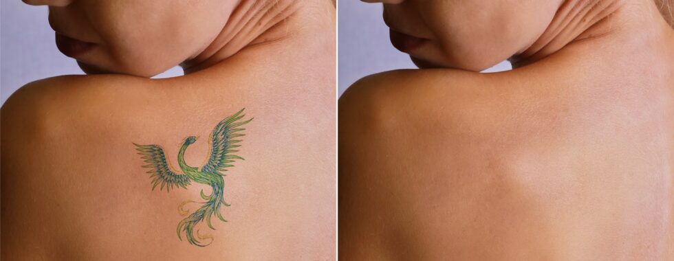 Tattoo Removal Alternatives