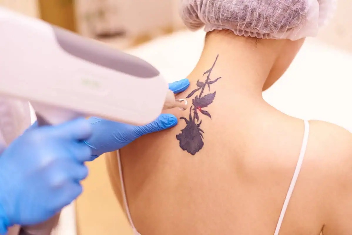 Tattoo Removal Alternatives