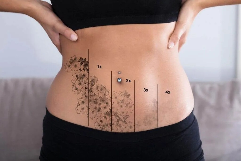 Tattoo Removal Alternatives