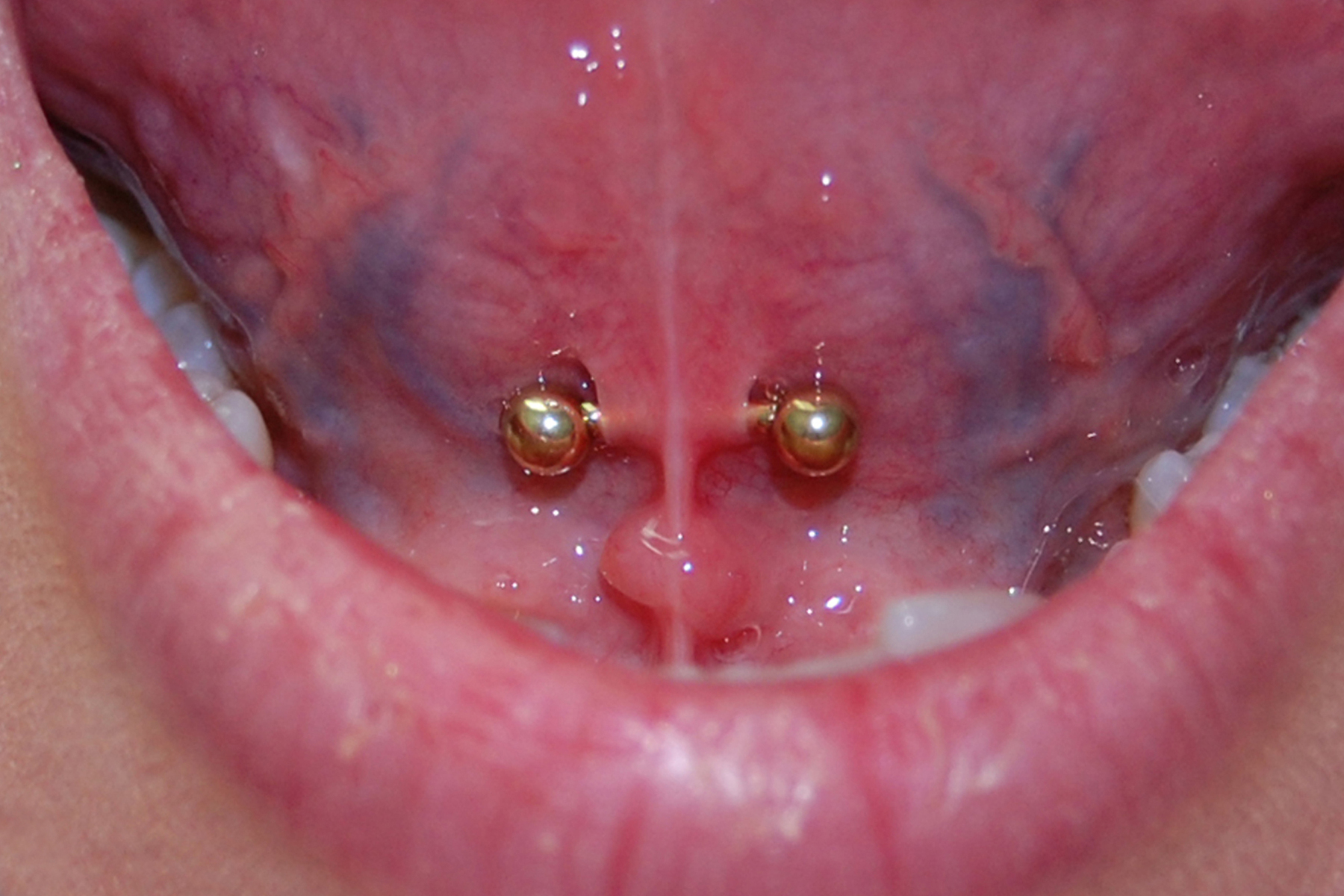tongue web piercing